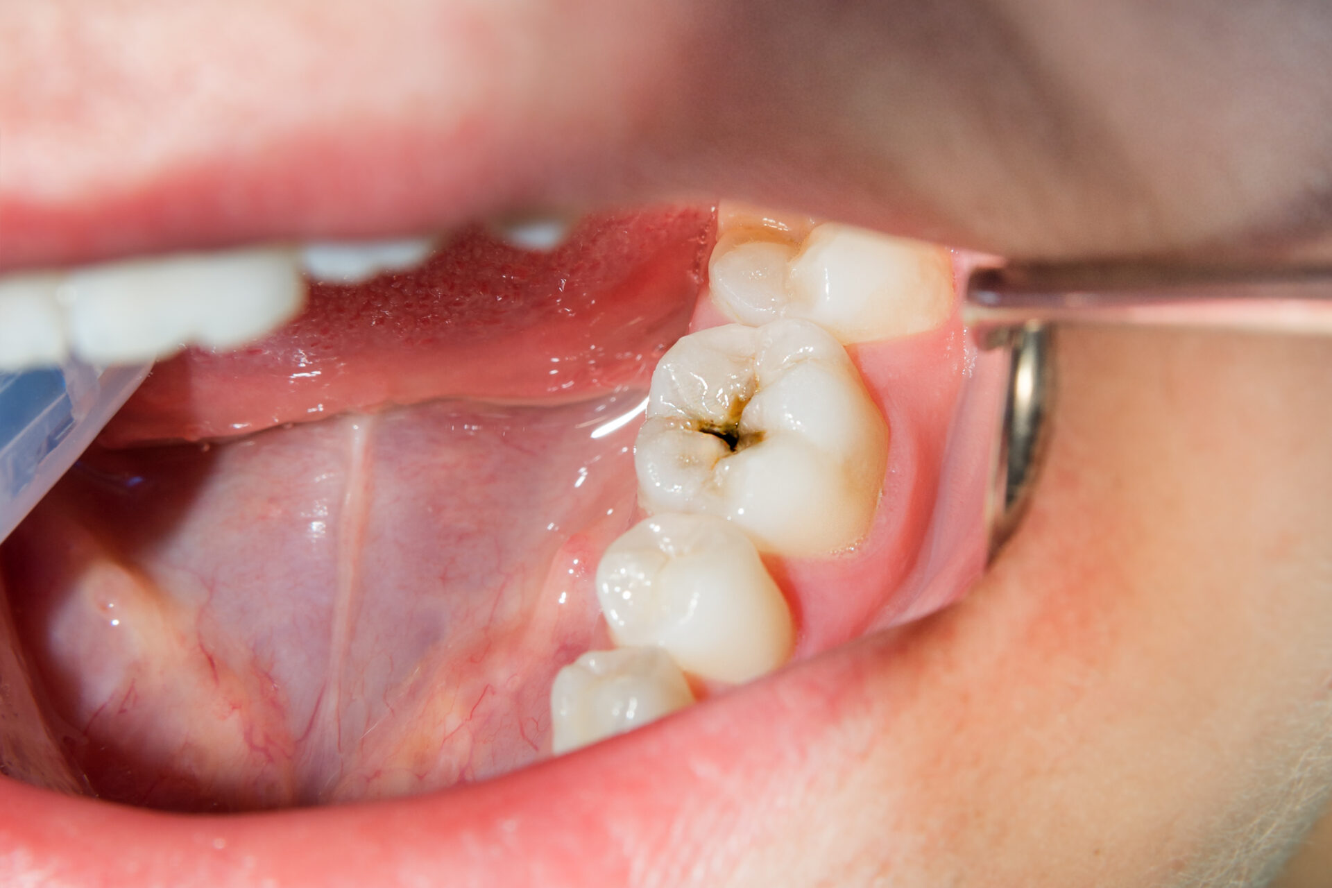 A dentist performing a teeth cleaning procedure on a woman, highlighting the importance of dental care.