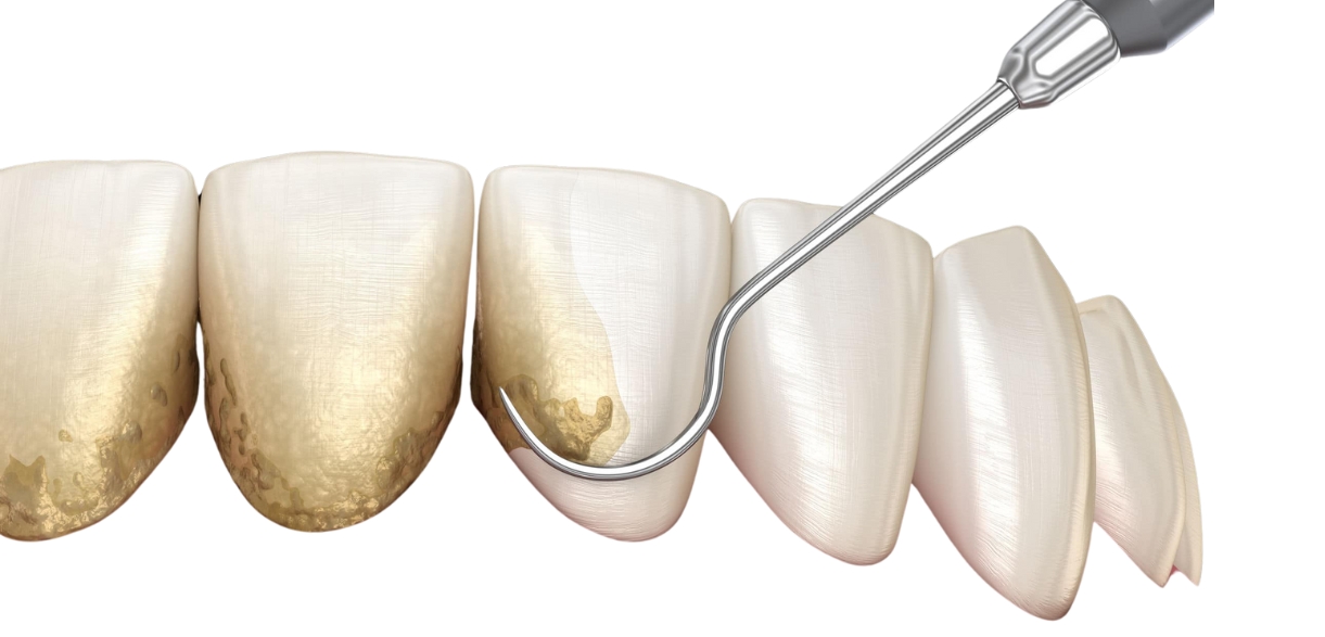 A dentist is extracting a tooth that has a gold filling, showcasing the dental procedure in action.