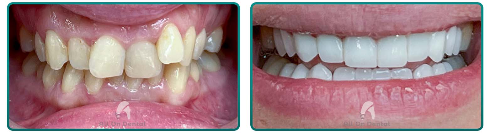 Before and after images showcasing the dramatic results of teeth whitening treatment.