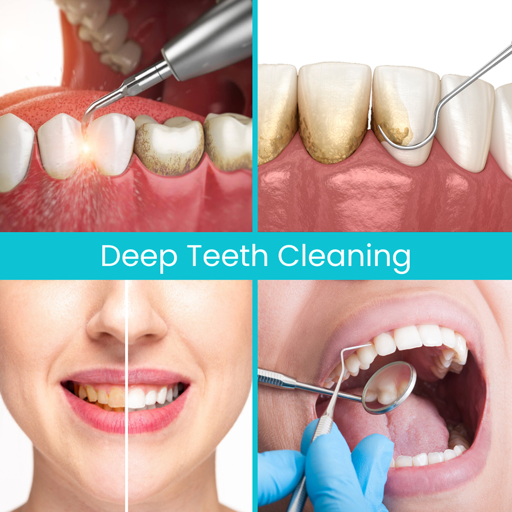 Image showing deep teeth cleaning process, highlighting before and after results for improved dental health.