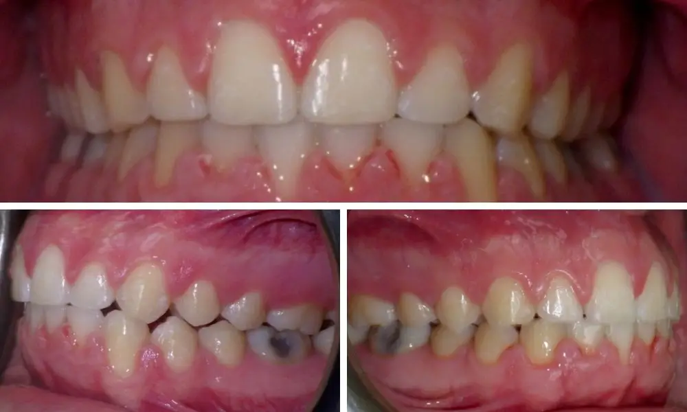 Before and after image showcasing the dramatic results of teeth whitening, highlighting improved brightness and smile confidence.