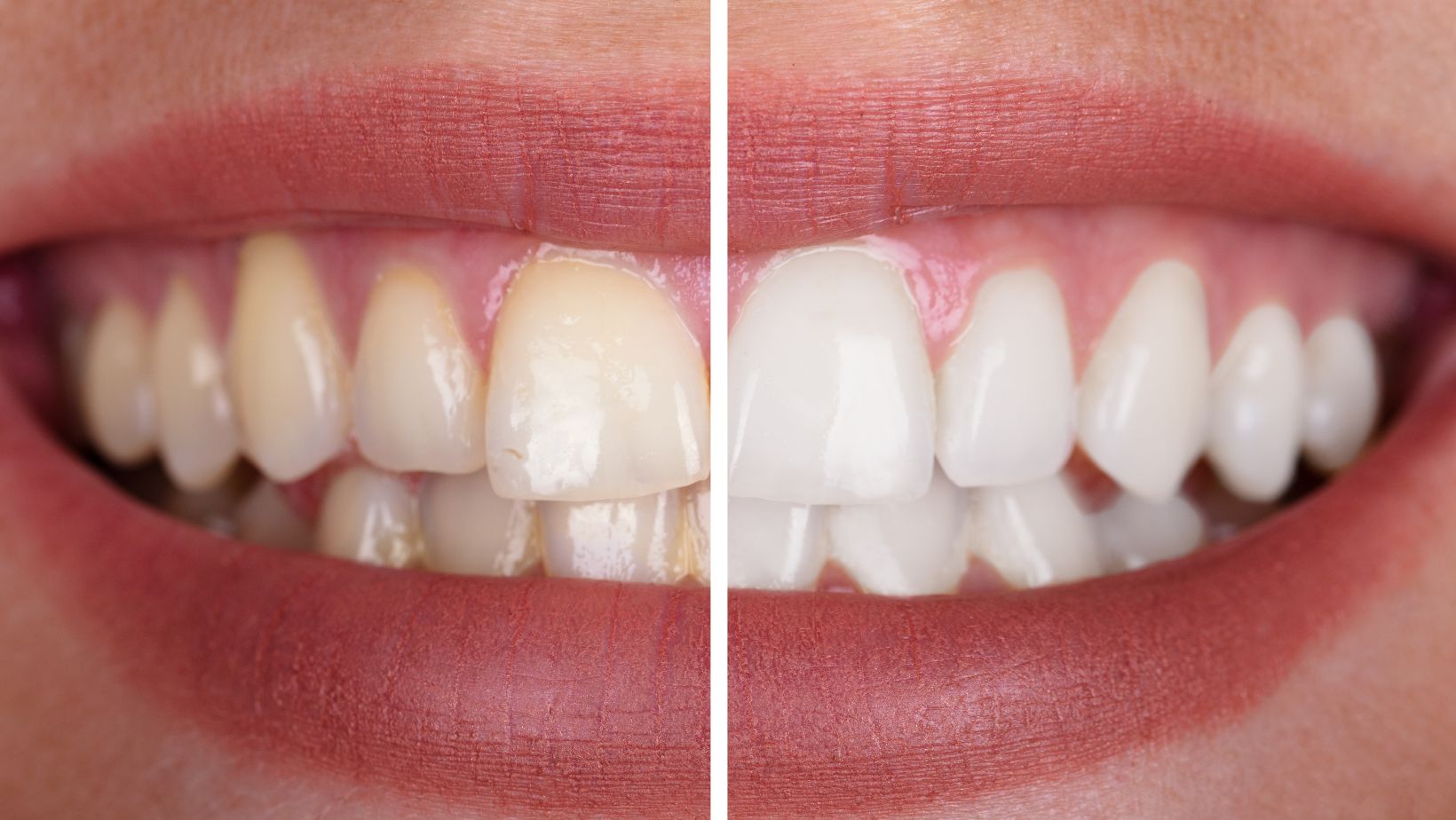 Before and after image showcasing the transformation of metal teeth following a teeth whitening treatment.