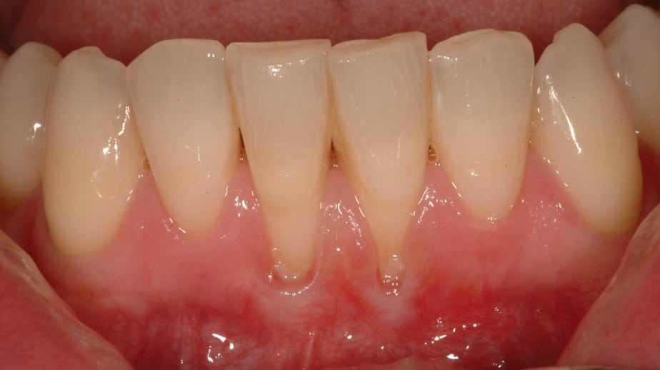 How Far Can Gums Recede Before Teeth Fall Out?