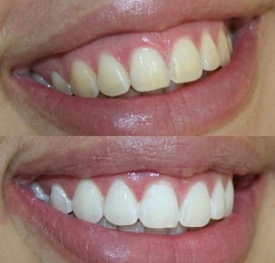 Pola Light Teeth Whitening: Achieve a Brighter Smile