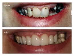 Teeth Crowns Before and After: Transform Your Smile