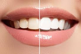 Teeth Whitening in Miami, FL: Brighten Your Smile Today